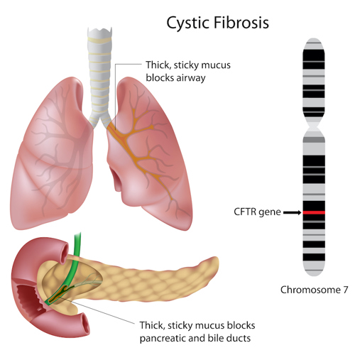 Cystic fibrosis