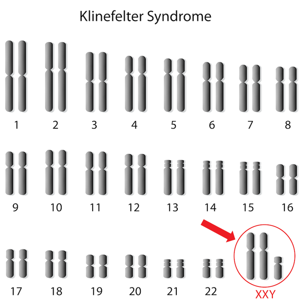 Chromosomes of someone with Klinefelter (XXY).