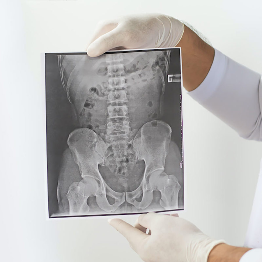 Spine X-ray.
