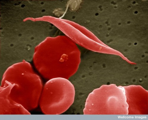 Sickle shaped blood cells