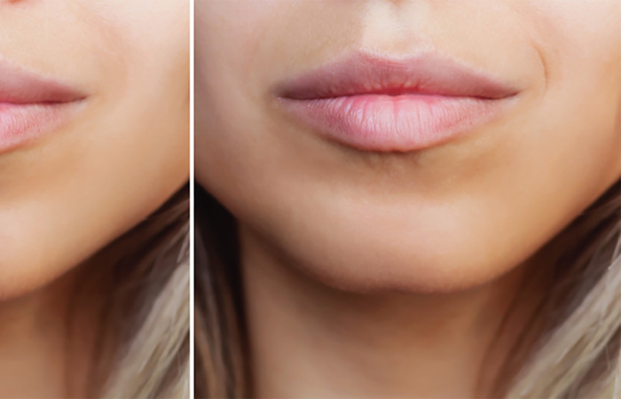 Cleft chin.