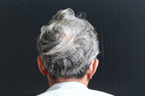 Grey hair.