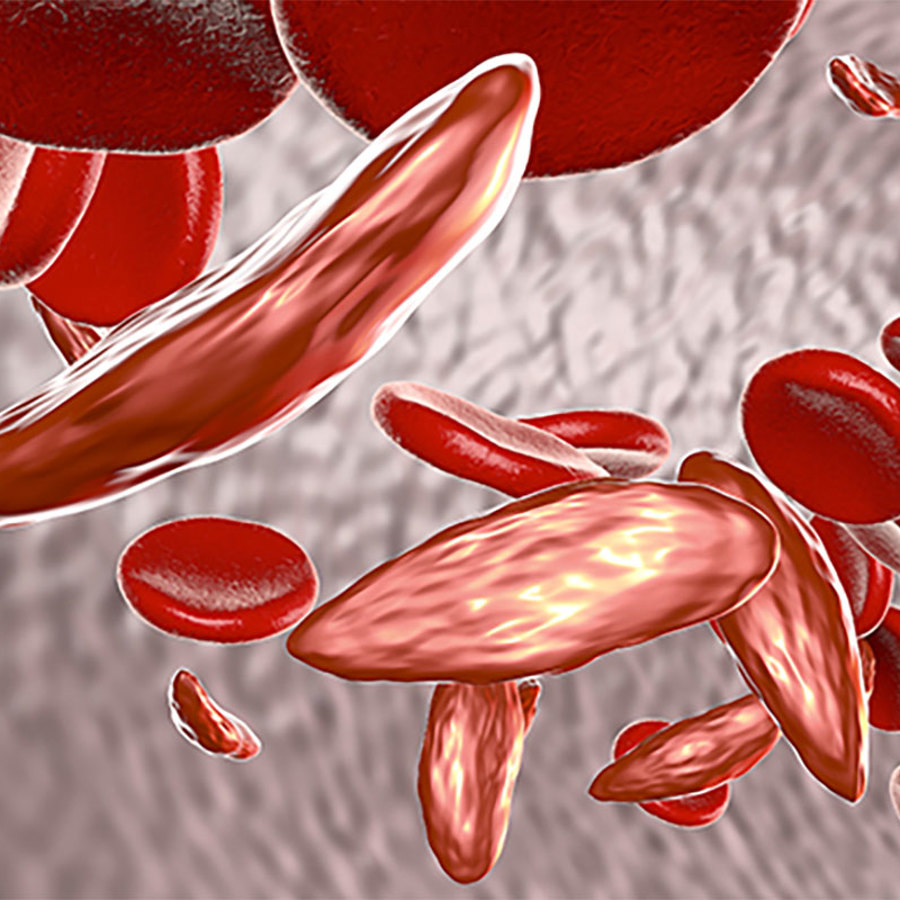 Sickle cell anemia 3D illustration.