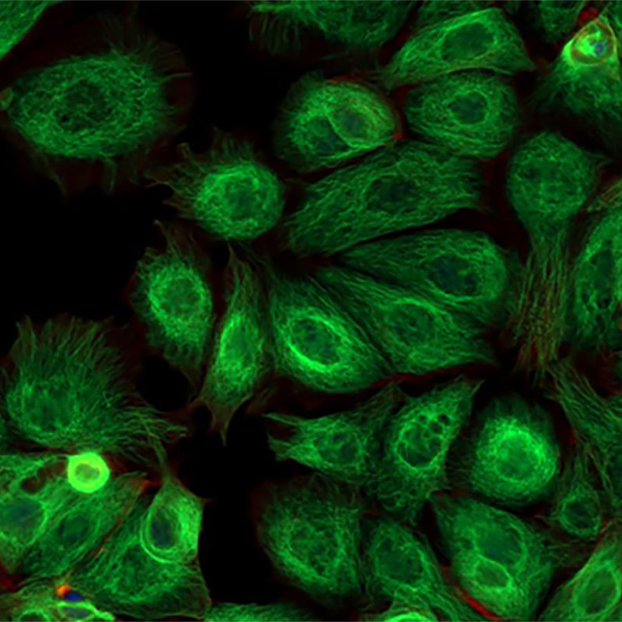 Green fluorescent protein (GFP) cancer cells.