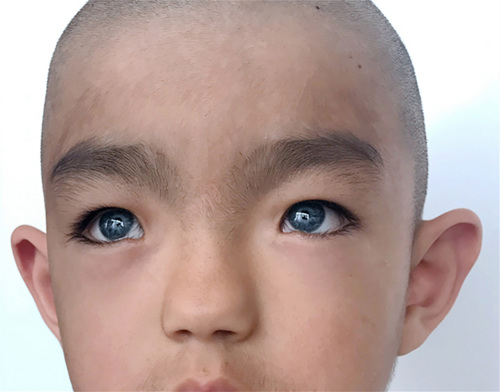 Waardenburg syndrome.