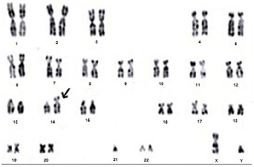 Karyotype with translocation.